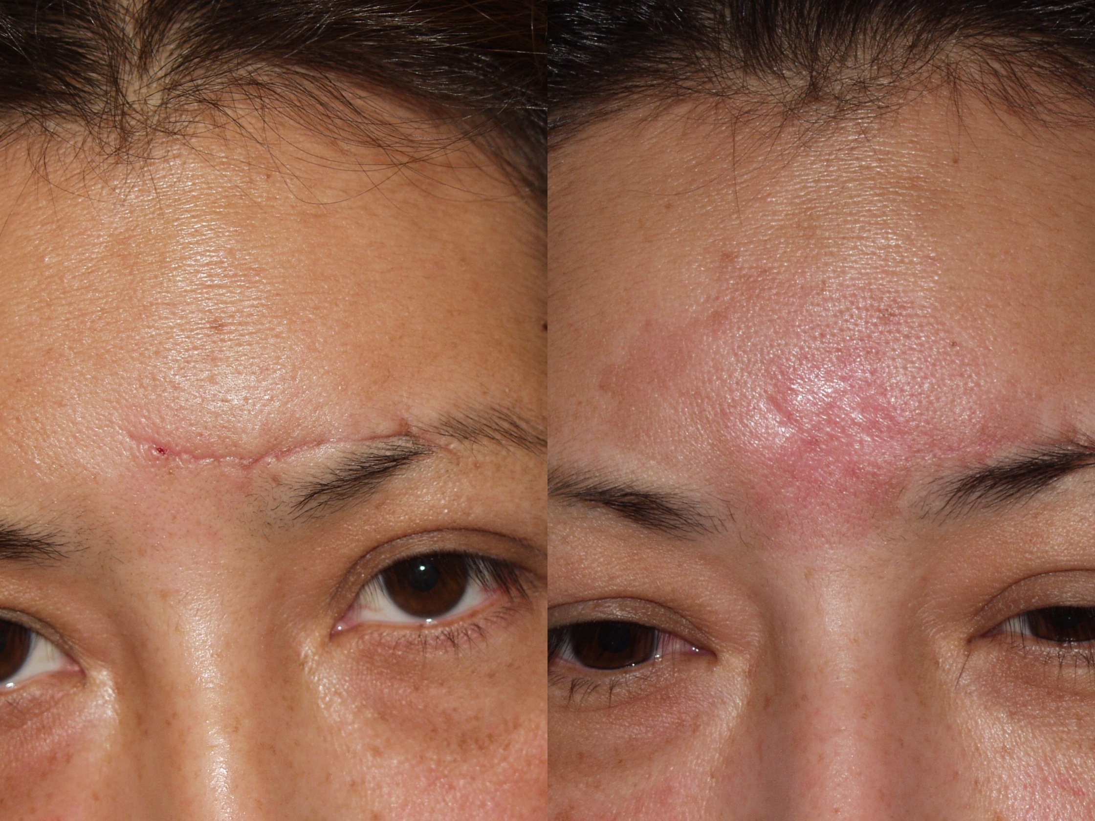 Facial Scar Surgery 86