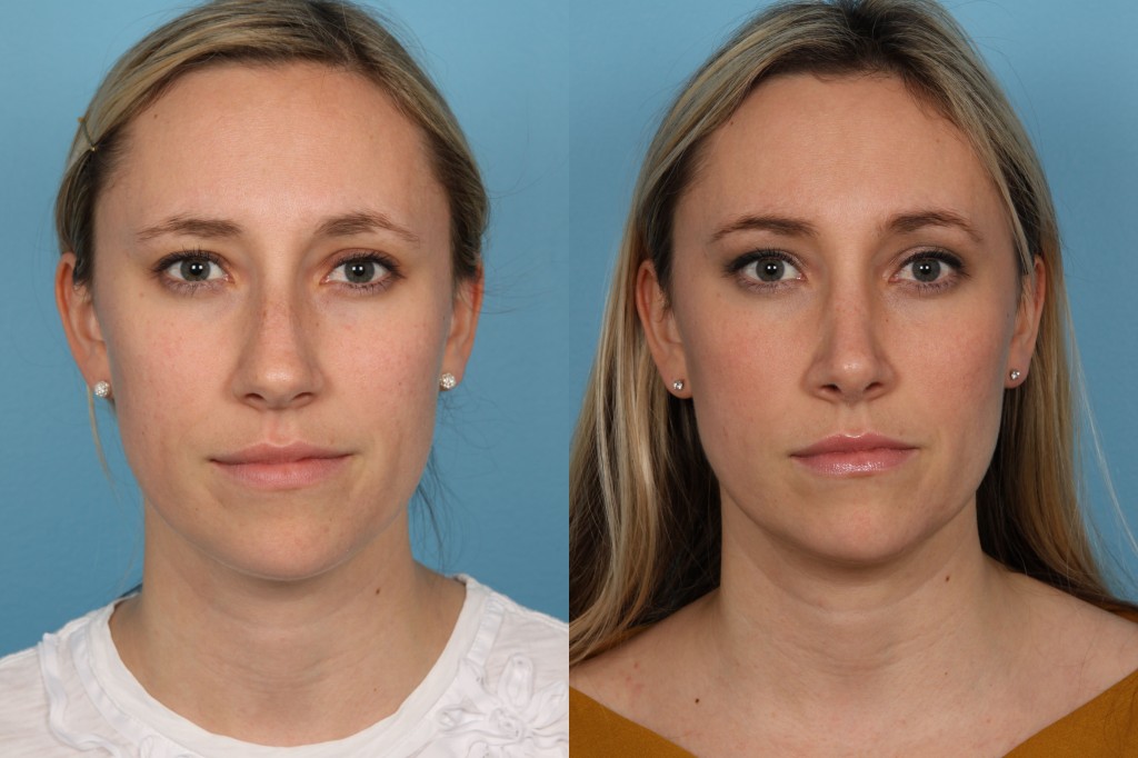Rhinoplasty (Nose Job)