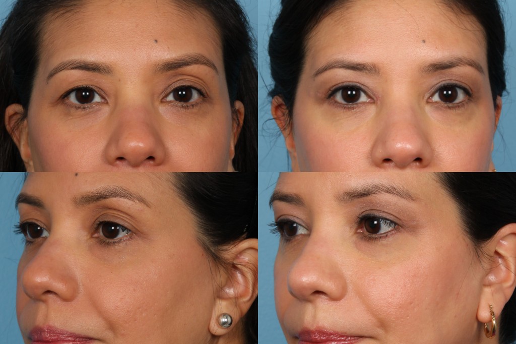Blepharoplasty (Eyelid Surgery)
