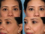 Blepharoplasty (Eyelid Surgery)