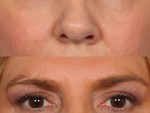 Blepharoplasty (Eyelid Surgery)