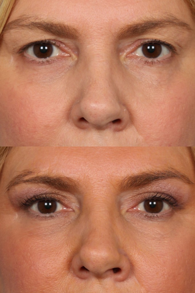 Blepharoplasty (Eyelid Surgery)