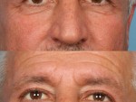 Blepharoplasty (Eyelid Surgery)