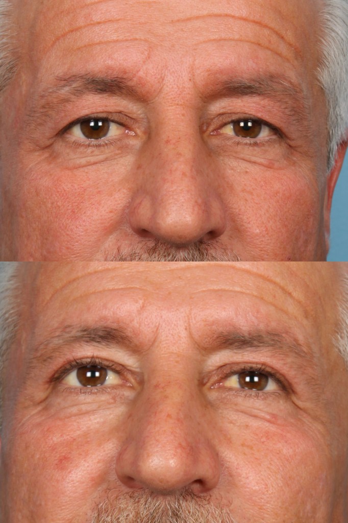 Blepharoplasty (Eyelid Surgery)
