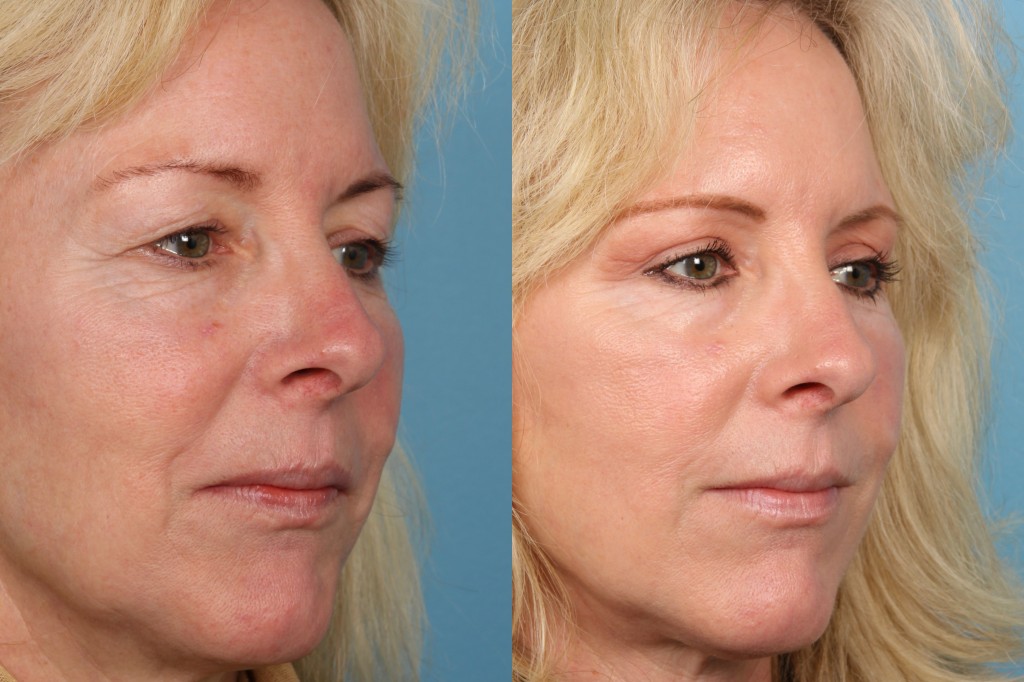 Blepharoplasty (Eyelid Surgery)