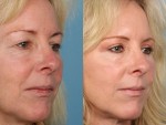 Blepharoplasty (Eyelid Surgery)