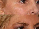 Blepharoplasty (Eyelid Surgery)