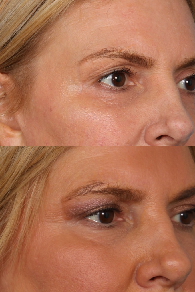 Blepharoplasty (Eyelid Surgery)