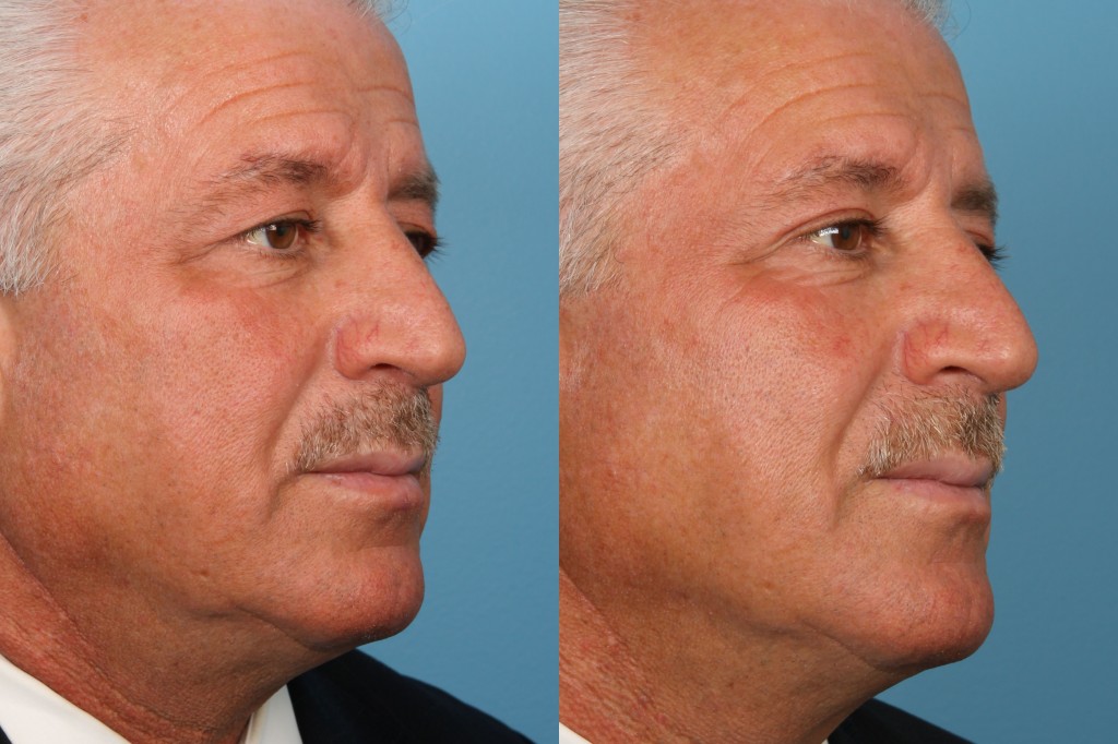 Blepharoplasty (Eyelid Surgery)