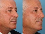 Blepharoplasty (Eyelid Surgery)