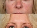 Blepharoplasty (Eyelid Surgery)