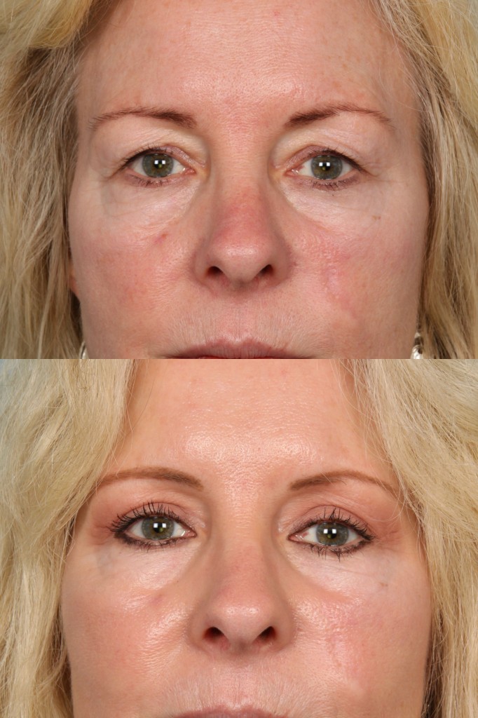 Blepharoplasty (Eyelid Surgery)