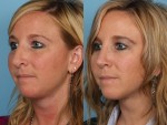 Revision Rhinoplasty