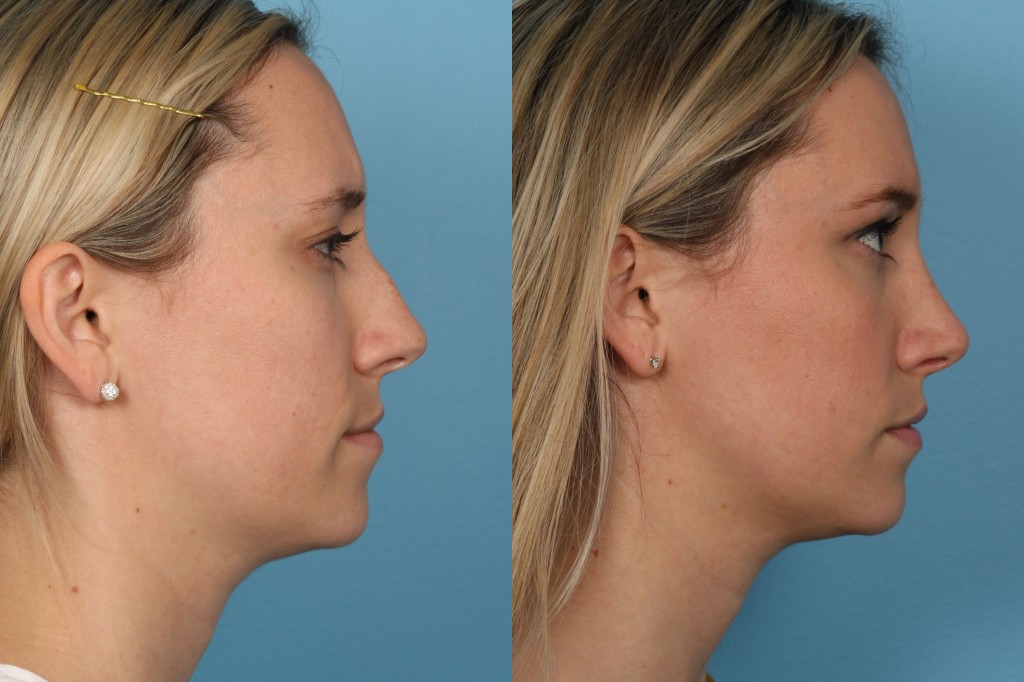 Rhinoplasty (Nose Job)