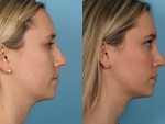 Rhinoplasty (Nose Job)