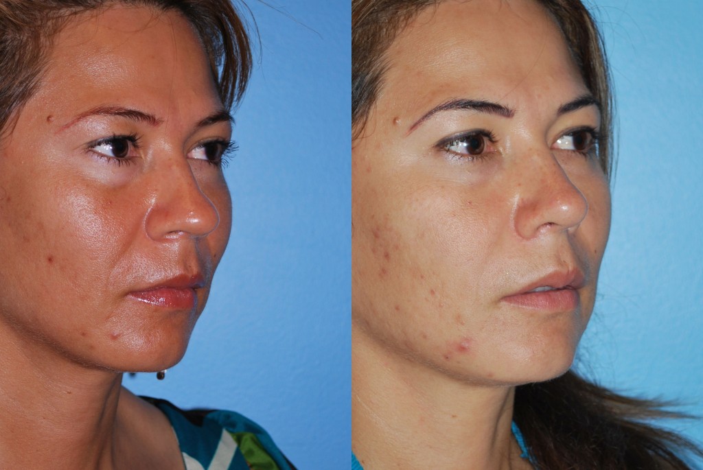 Rhinoplasty (Nose Job)
