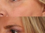 Blepharoplasty (Eyelid Surgery)