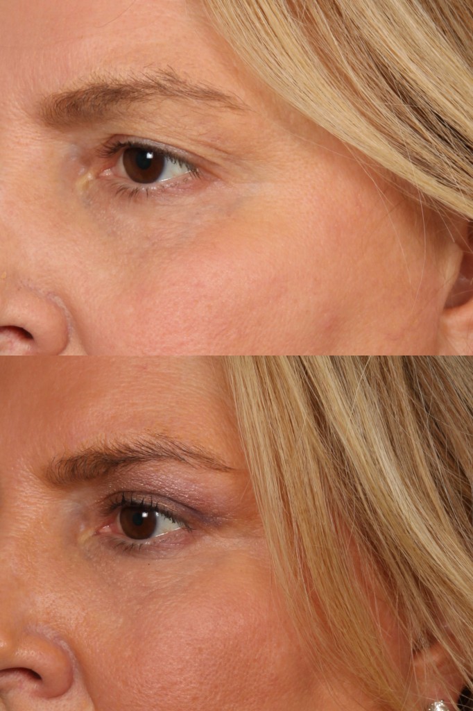 Blepharoplasty (Eyelid Surgery)
