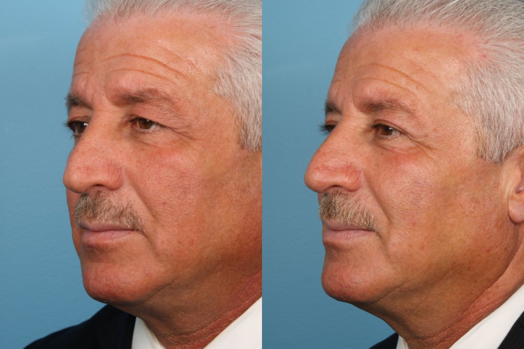 Blepharoplasty (Eyelid Surgery)