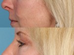 Blepharoplasty (Eyelid Surgery)