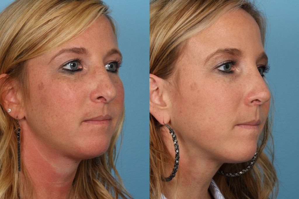 Revisions Rhinoplasty