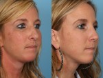 Revision Rhinoplasty