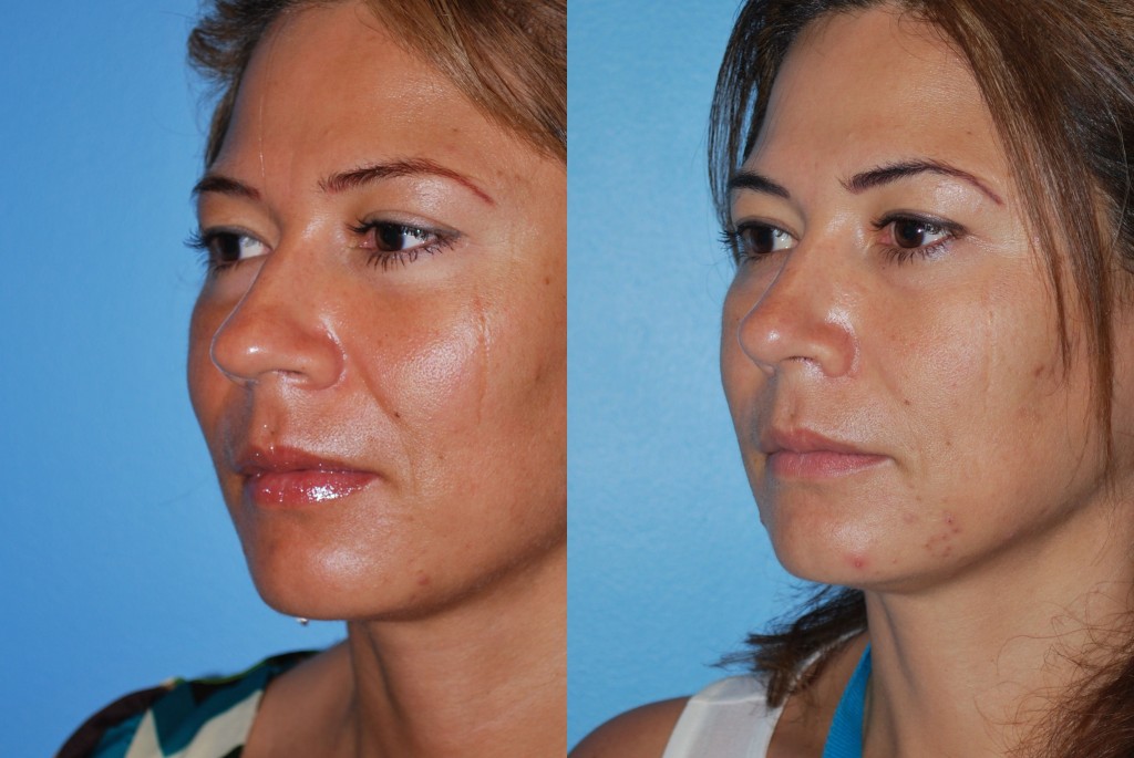 Rhinoplasty (Nose Job)