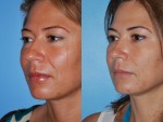 Rhinoplasty (Nose Job)