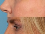 Blepharoplasty (Eyelid Surgery)