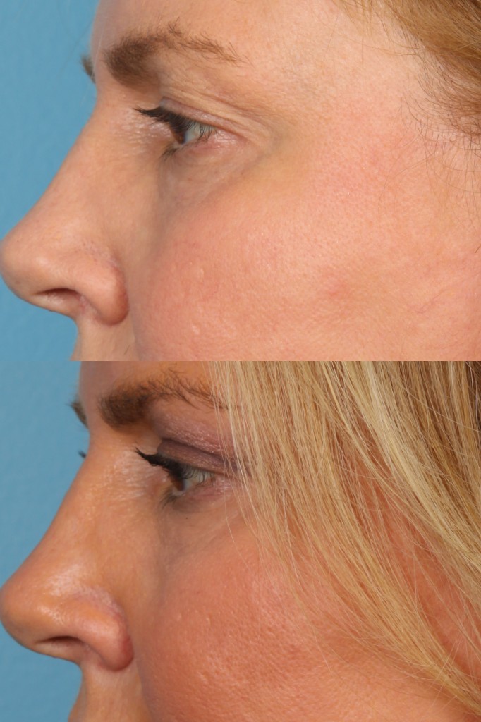 Blepharoplasty (Eyelid Surgery)