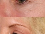 Blepharoplasty (Eyelid Surgery)