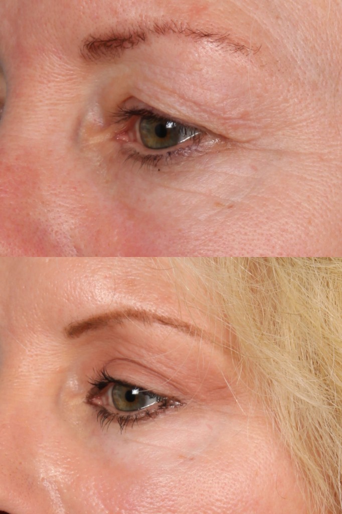 Blepharoplasty (Eyelid Surgery)