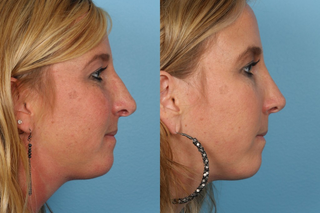 Revisions Rhinoplasty