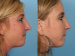 Revision Rhinoplasty