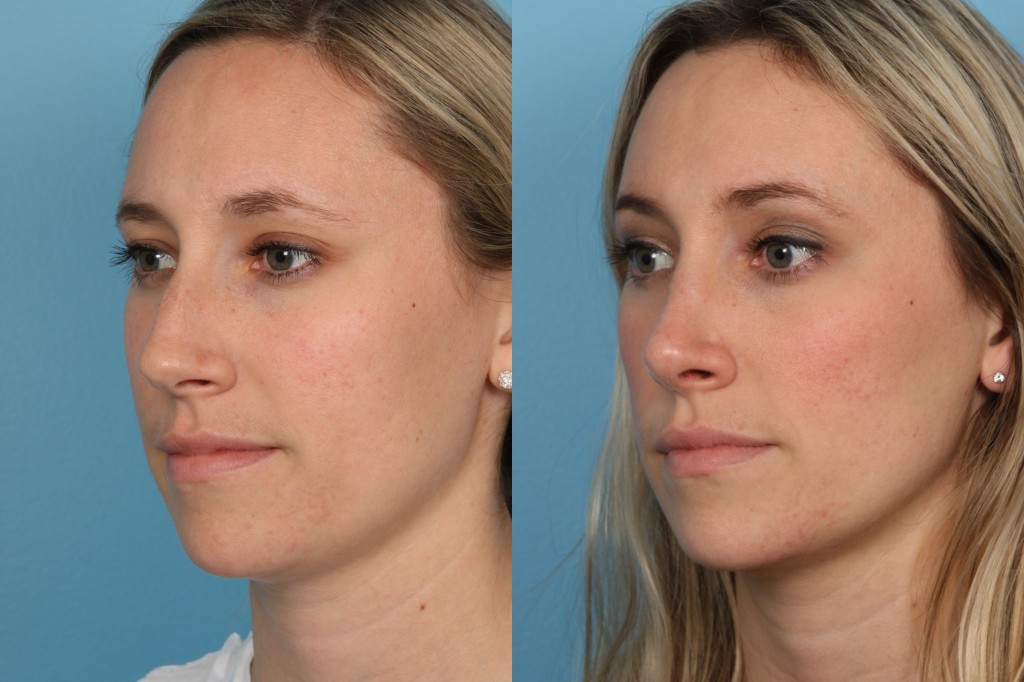 Rhinoplasty (Nose Job)
