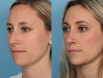 Rhinoplasty (Nose Job)