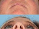 Revision Rhinoplasty