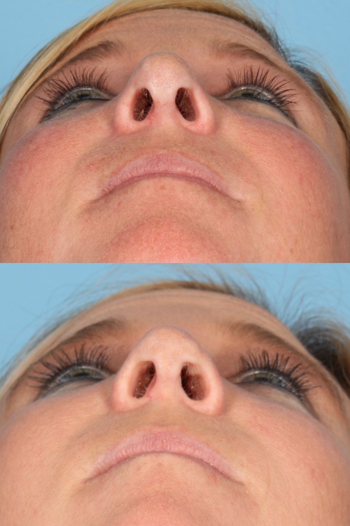 Revisions Rhinoplasty