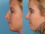 Revision Rhinoplasty