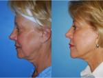 Facelift and Necklift