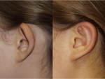 Otoplasy (Ear Pinning)
