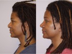 Rhinoplasty (Nose Job)