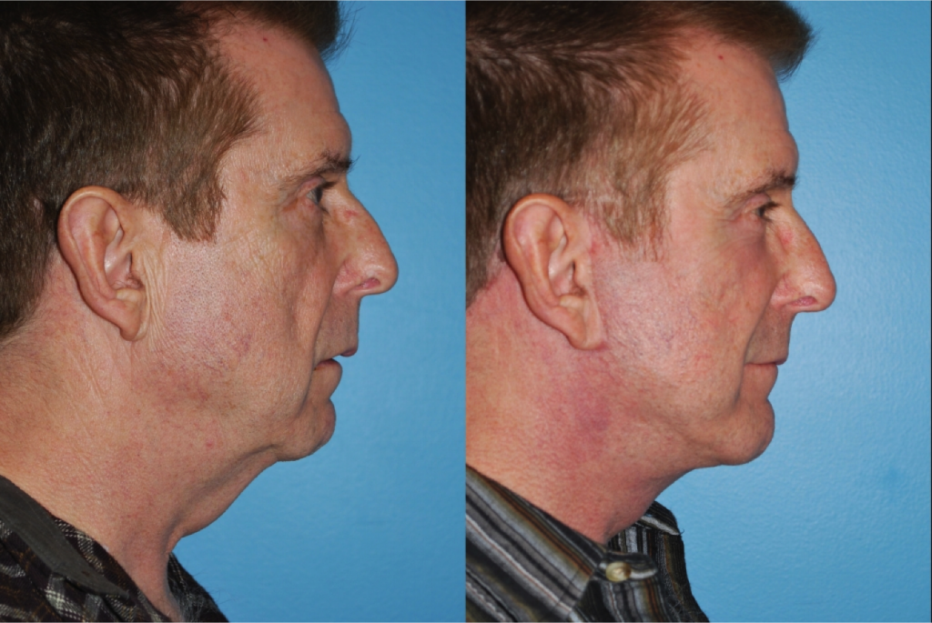 Facelift and Necklift