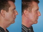 Facelift and Necklift