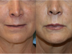 Lip Augmentation & Injection