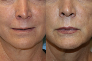 Lip Augmentation & Injection