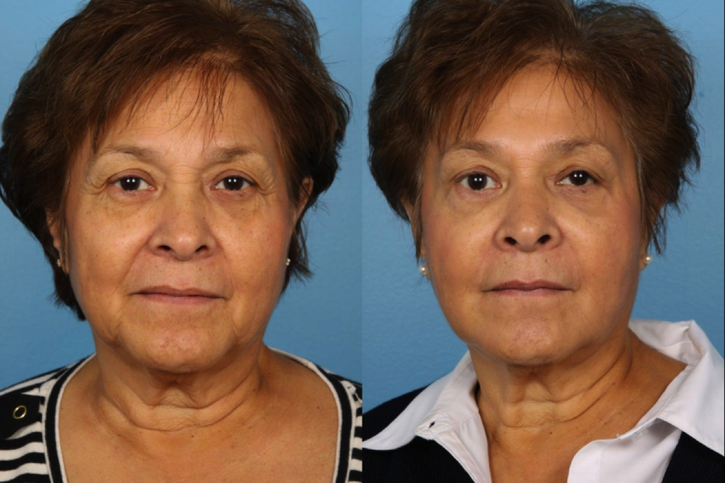 Facial Lines and Wrinkles