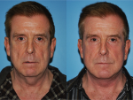 Facelift and Necklift