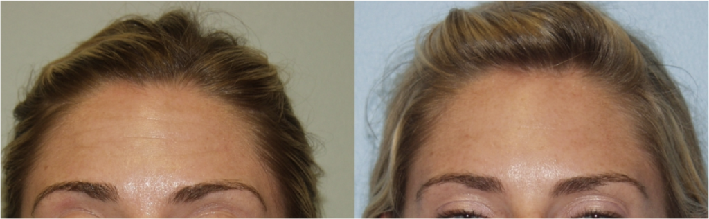 Botox and Injectables