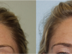 Botox and Injectables